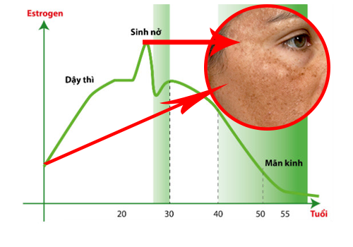 90% phụ nữ không biết cách điều trị nám da do nội tiết như thế nào?