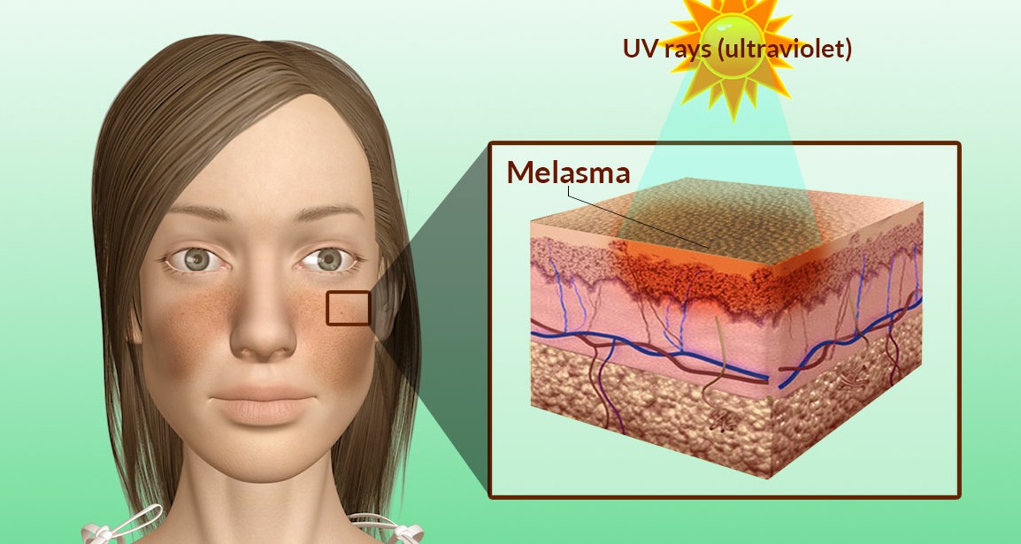 Muốn trị nám hiệu quả đừng bỏ qua mùa đông