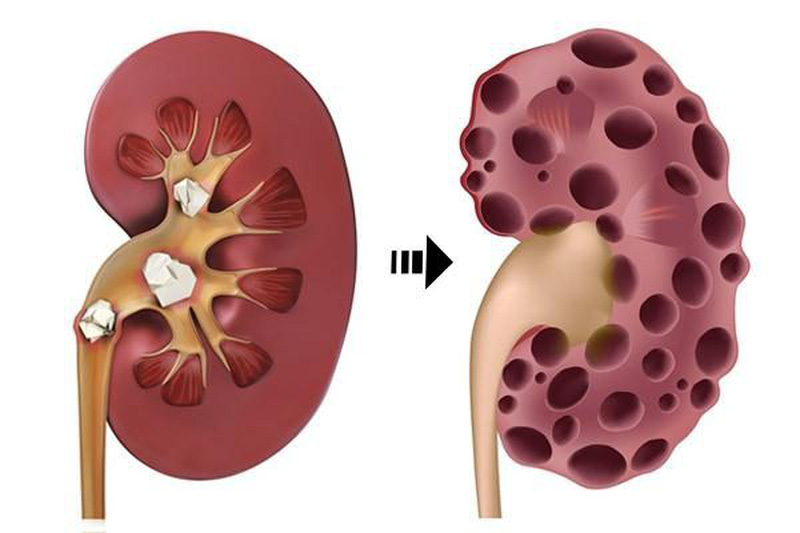 Bệnh sỏi thận  Triệu chứng và cách chữa  Tuệ Linh