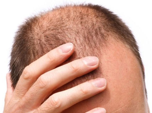 Nguyên nhân gây rụng tóc ở nam giới và cách phòng tránh