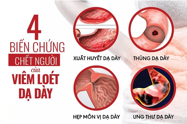 Biến Chứng Viêm Loét Dạ Dày Tá Tràng: Những Điều Bạn Cần Biết