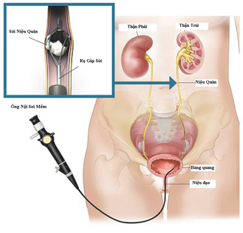 Cách Đẩy Sỏi Thận Ra Ngoài: Phương Pháp Hiệu Quả và An Toàn