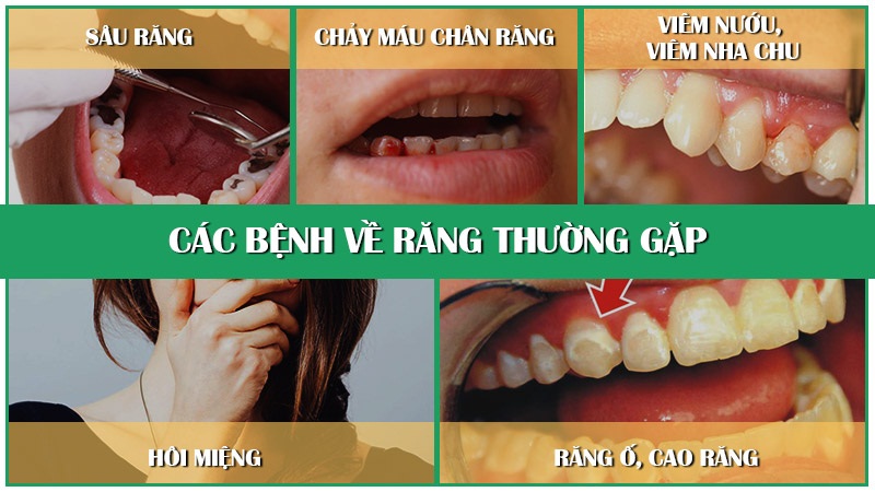 Top 5 bệnh răng miệng thường gặp