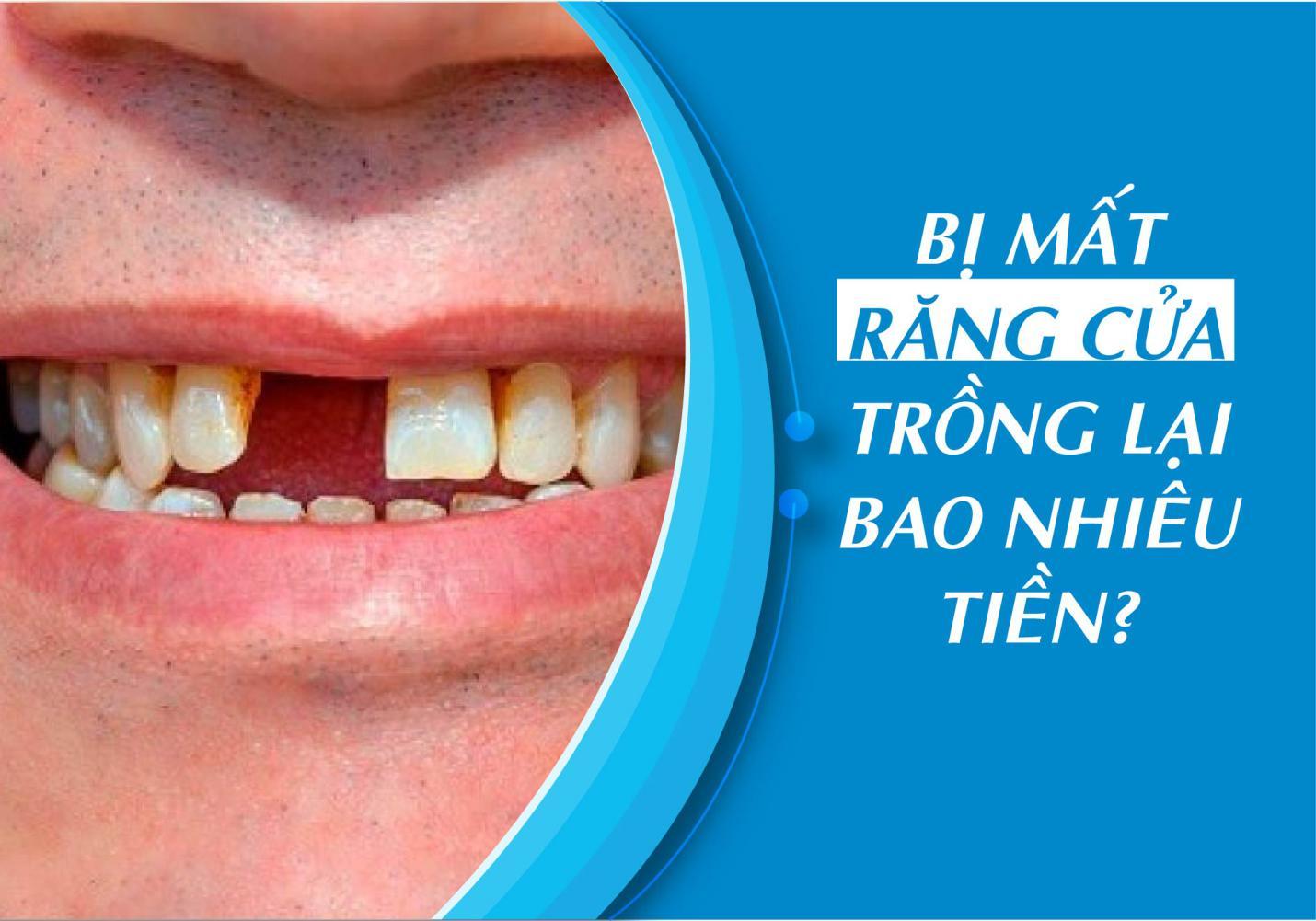 Bị mất răng cửa chi phí trồng lại là bao nhiêu?