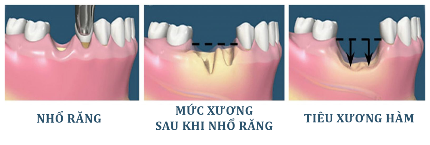 8 ưu đãi khi trồng răng Implant tại Nha khoa Đông Nam