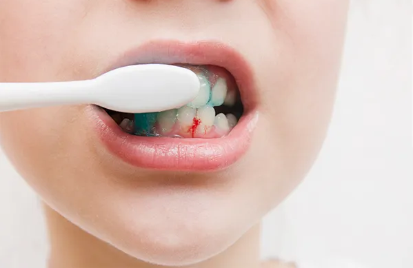 Chảy máu chân răng khi đánh răng – không thể chủ quan