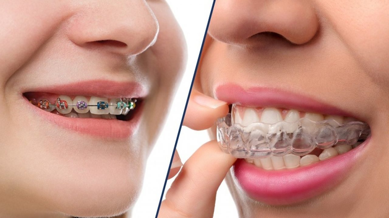 Giải oan” cho niềng răng Invisalign