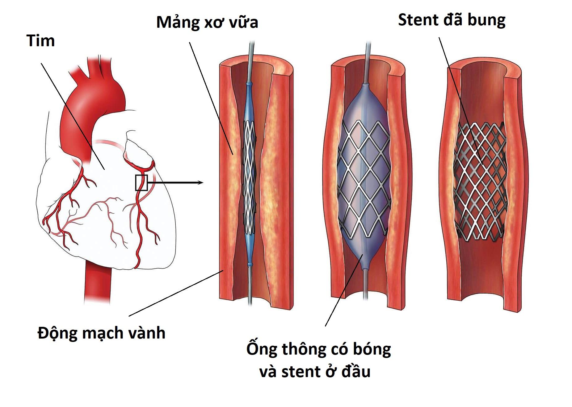 Замена стентов. Стентирование сосудов сердца. Коронарная ангиопластика. Стентирование сосудов нижних конечностей. Коронарное стентирование сосудов сердца.
