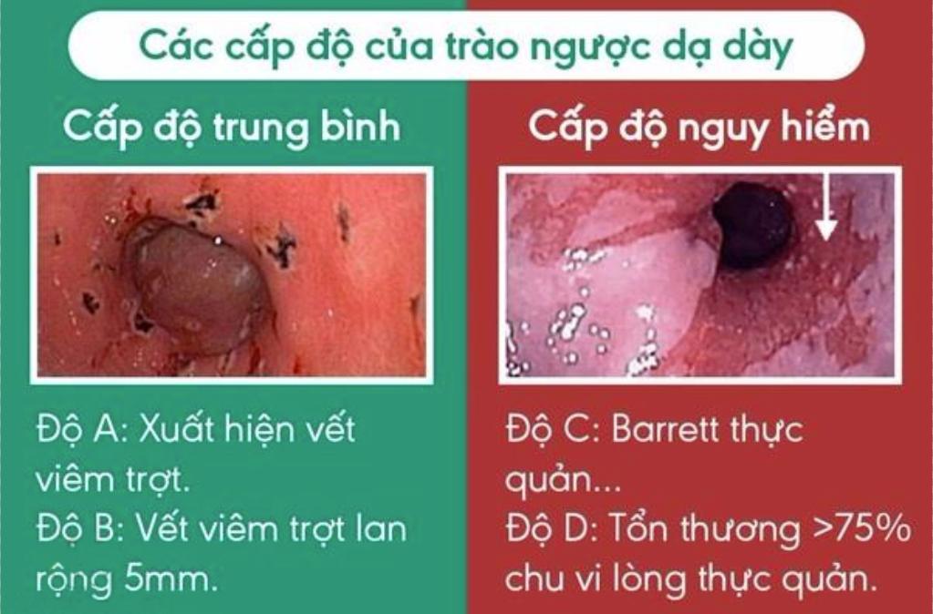 Lời khuyên cho người bệnh trào ngược dạ dày thực quản