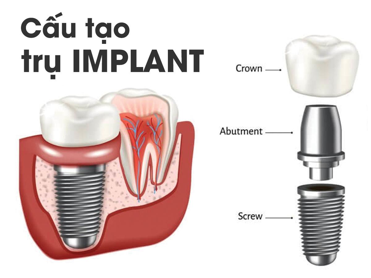 Địa chỉ trồng răng implant giá rẻ, an toàn uy tín, hiệu quả tại Hà Nội