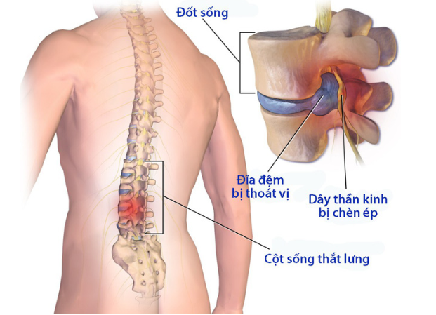 Hậu quả và các biến chứng của bệnh thoái hóa cột sống lưng và cột sống cổ