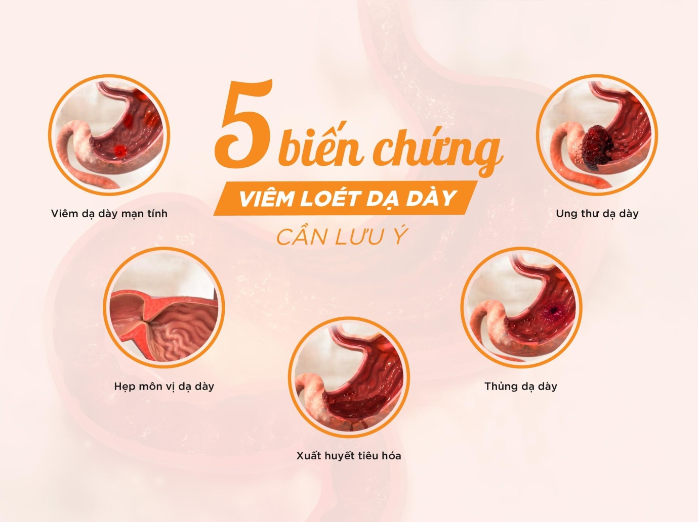 7. Biến chứng của bệnh viêm dạ dày