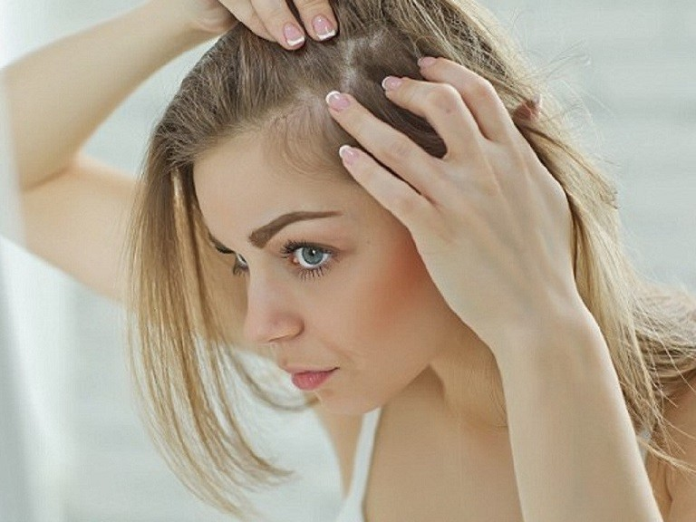 Da đầu thường tróc vảy, mẩn đỏ - nguyên nhân và cách điều trị
