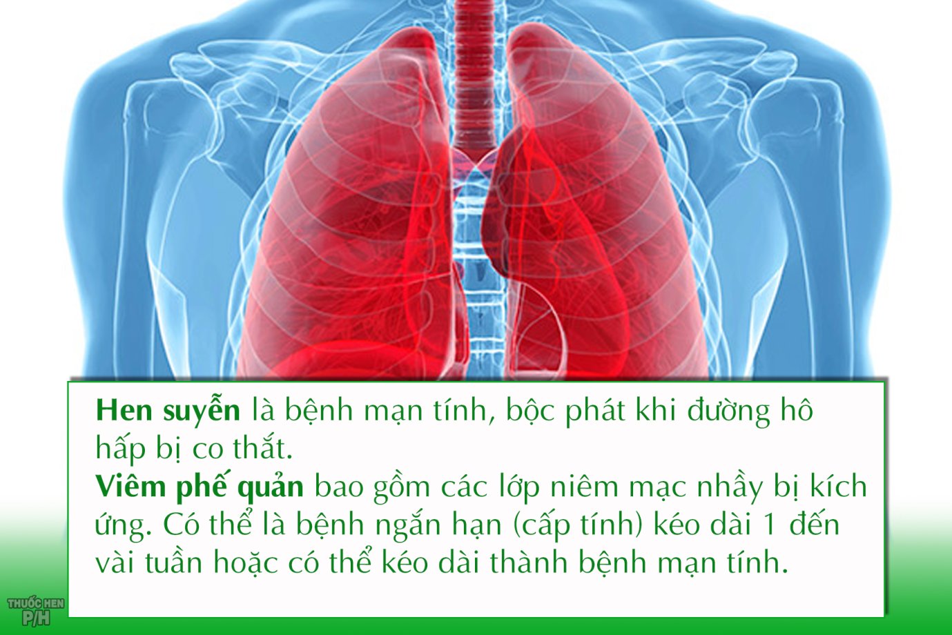 Hen Phế Quản Và Viêm Phế Quản: Nguyên Nhân, Triệu Chứng Và Phương Pháp Điều Trị Hiệu Quả