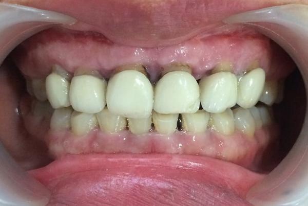Hậu quả nghiêm trọng khi bọc răng sứ kém chất lượng?