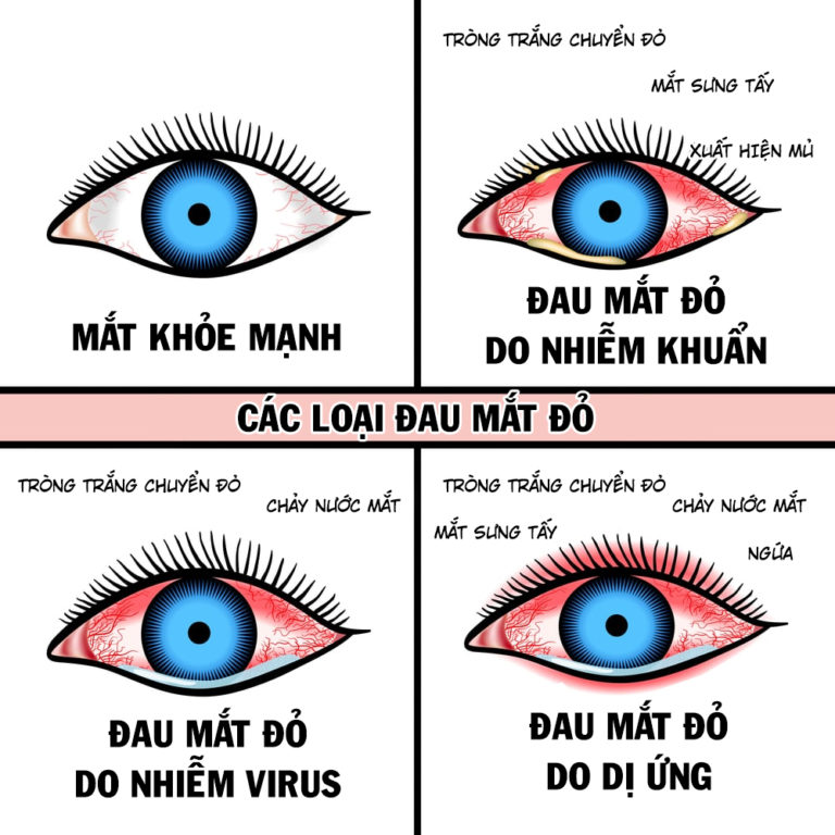 Những bệnh thường gặp về mắt