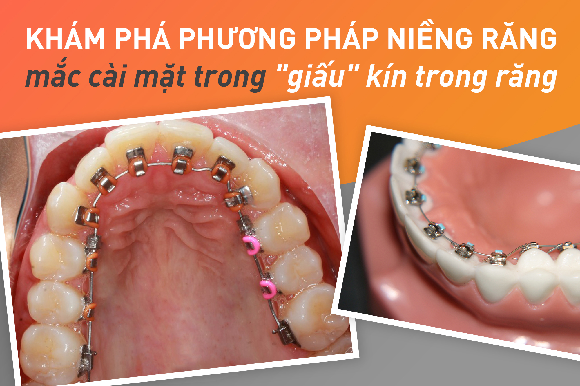 Thông Tin Niềng Răng và Chi Phí Tại Việt Nam