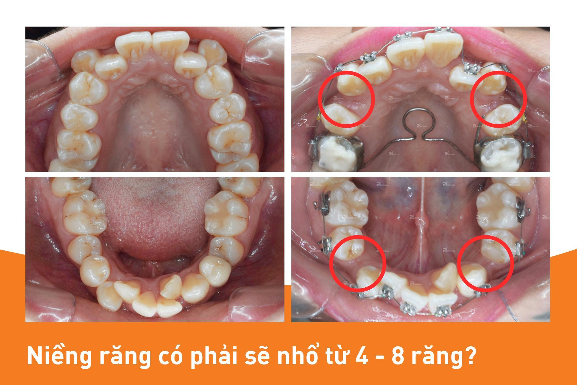 Khi niềng răng phải nhổ răng nào?