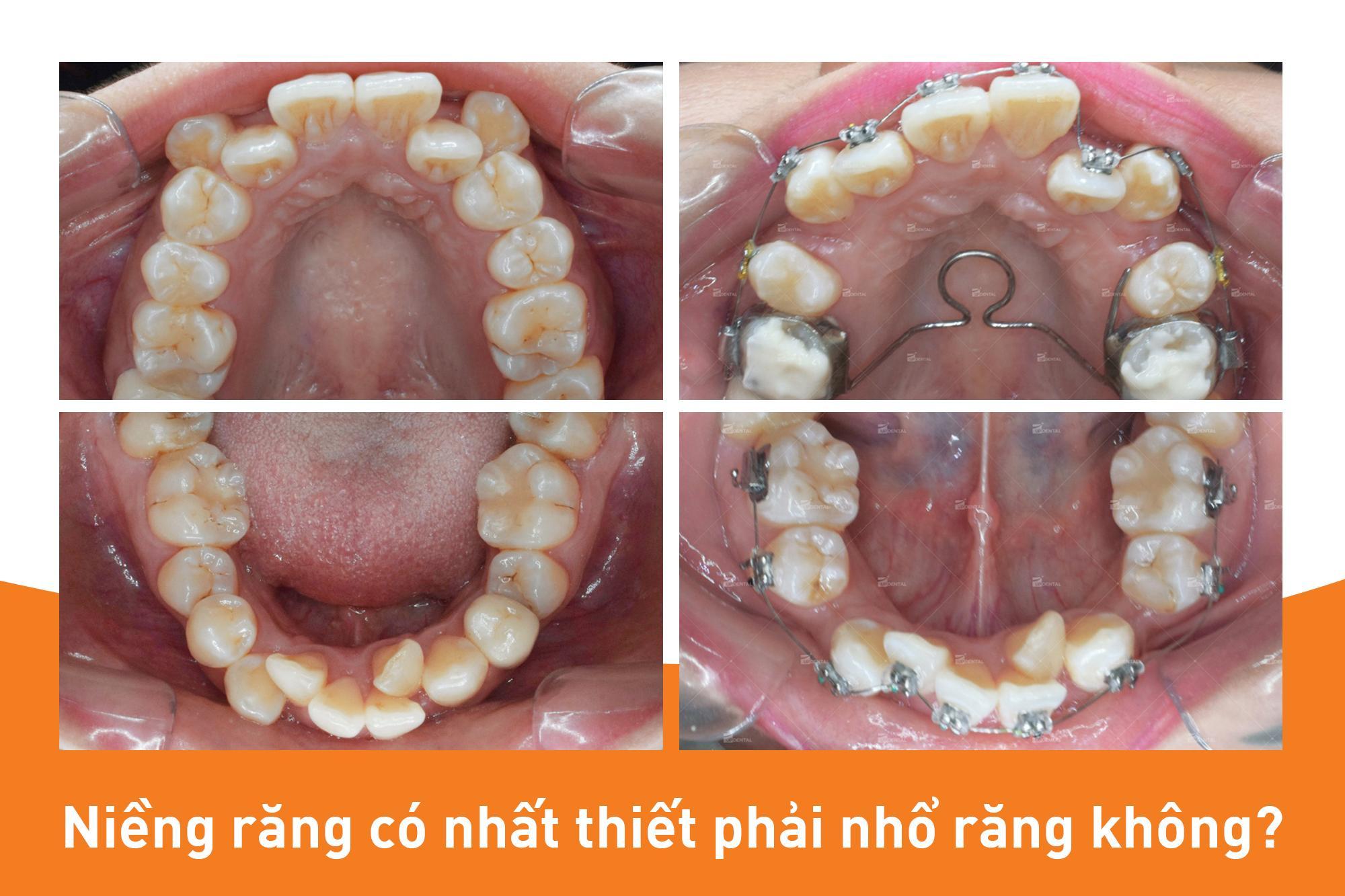 Nhổ răng khi niềng răng có ảnh hưởng gì không?