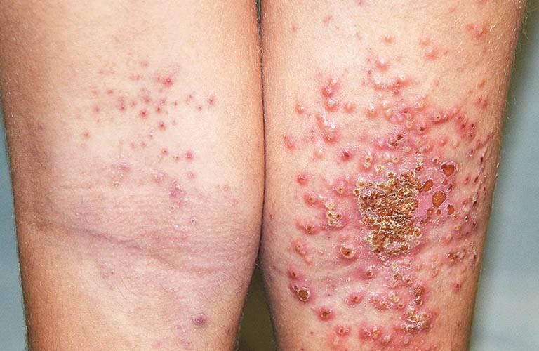 Điều Trị Bệnh Chàm (Eczema)