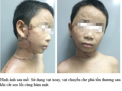 Phẫu thuật, điều trị thành công sẹo lồi gây biến dạng mặt cho trẻ 9 tuổi