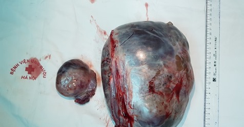 Trẻ đi ngoài phân đen, nôn ra máu là bệnh gì, có nguy hiểm không?- Ảnh 2. Trẻ đi ngoài phân đen, nôn ra máu là bệnh gì, có nguy hiểm không?- Ảnh 2.