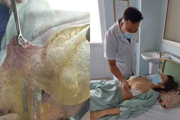 Người phụ nữ ở Hà Nội bị vỡ túi silicon sau 6 năm nâng ngực