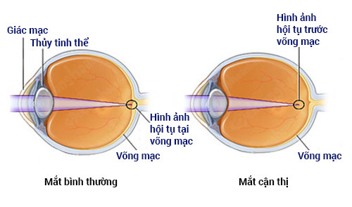 Thực trạng cận thị học đường và cong vẹo cột sốt ngày càng tăng