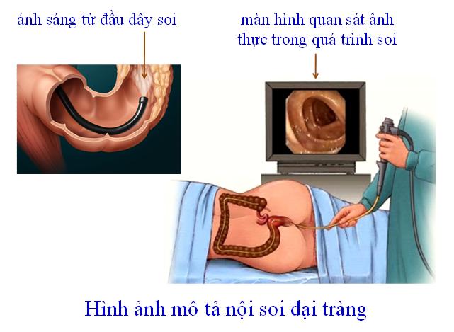 Xét nghiệm phát hiện 3 loại ung thư đường tiêu hóa dễ mắc phải