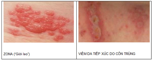 Phòng ngừa và xử trí đúng cách côn trùng đốt khi du xuân tránh biến chứng nguy hiểm- Ảnh 3. Côn trùng đốt – chớ coi thường