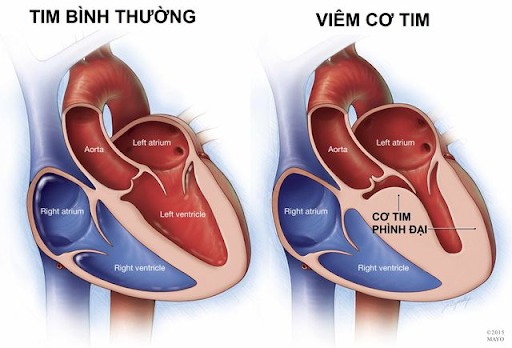 Phòng Ngừa Viêm Cơ Tim