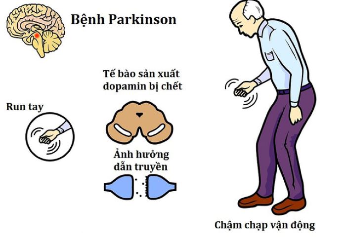 Cách nhận biết sớm dấu hiệu Parkinson