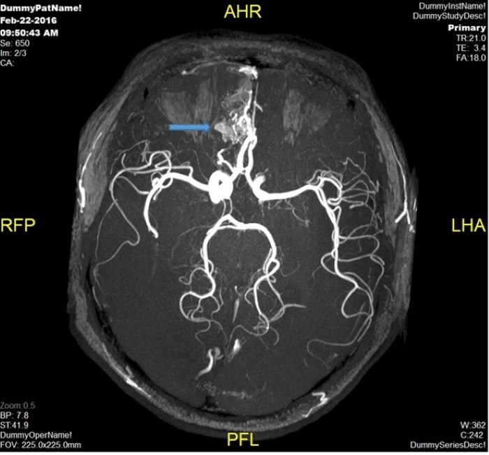 Phát hiện tổn thương não ở bệnh nhân COVID-19 qua MRI