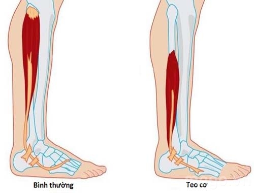 teo co, thuoc dau tien tri benh teo co Duchenne