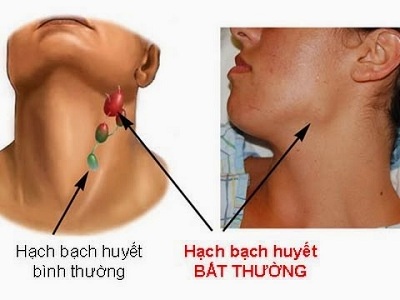 Thuốc mới trị u lympho dòng tế bào B lớn lan tỏa
