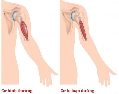 Thuốc mới trị bệnh loạn dưỡng cơ Duchenne do đột biến gen