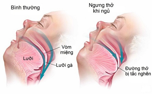 Rối loạn giấc ngủ làm tăng nguy cơ mắc Alzheimer