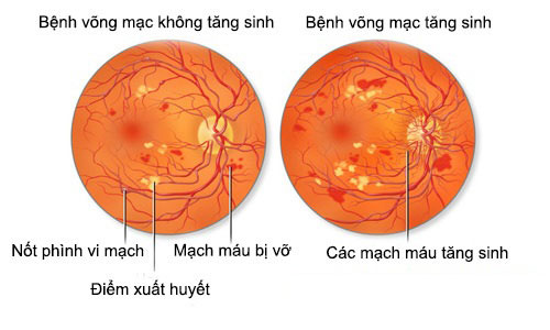 Thuốc giúp ngăn ngừa bệnh võng mạc tiểu đường