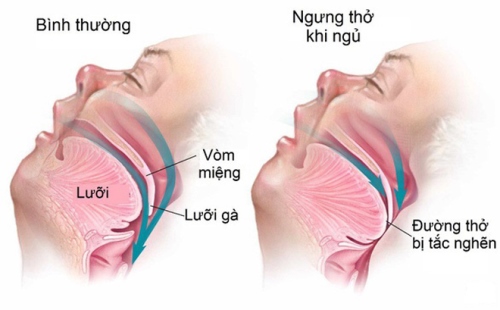 Điều trị ngưng thở khi ngủ, giúp giảm nguy cơ mắc Alzheimer