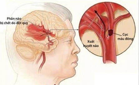 6. Điều trị và quản lý bệnh đột quỵ