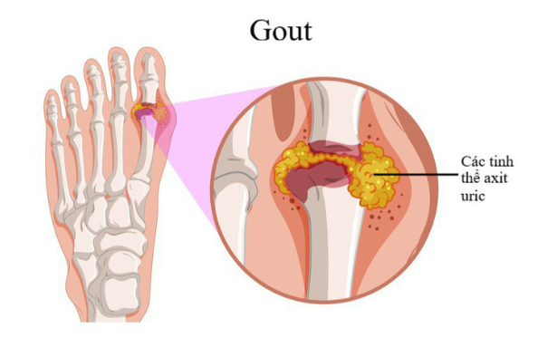 Kết hợp 2 loại thuốc: Giải pháp mới điều trị cho người mắc bệnh gút kháng trị