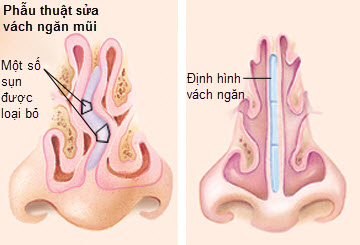 Làm sao phát hiện vẹo vách ngăn mũi?