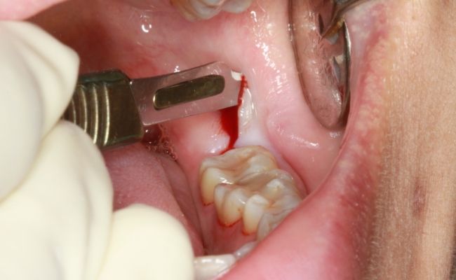 Sốt sau khi nhổ răng phải làm gì?