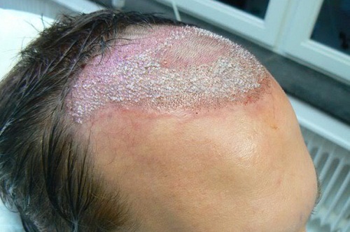 Spa Thu Linh Dịch vụ cấy tóc công nghệ cao không xâm lấn