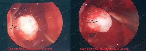 4. Các Phương Pháp Điều Trị U Xương Xoang Trán