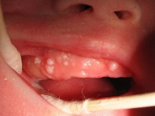 Các bác sĩ chỉ rõ cách xử lý răng nanh của trẻ sơ sinh