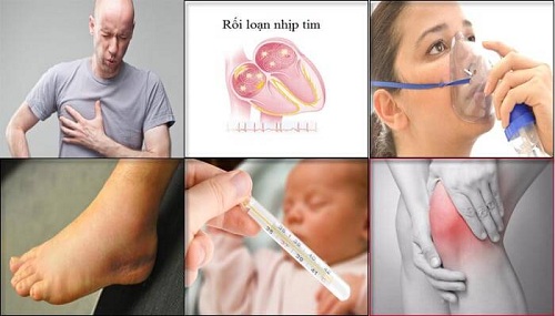 Dấu hiệu bệnh viêm cơ tim: Nhận biết và chăm sóc sức khỏe tim mạch