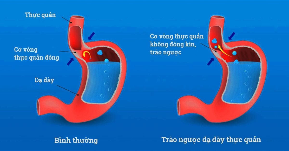 Một nguyên nhân sâu xa có thể là thủ phạm khiến trào ngược khó trị và dễ  tái phát