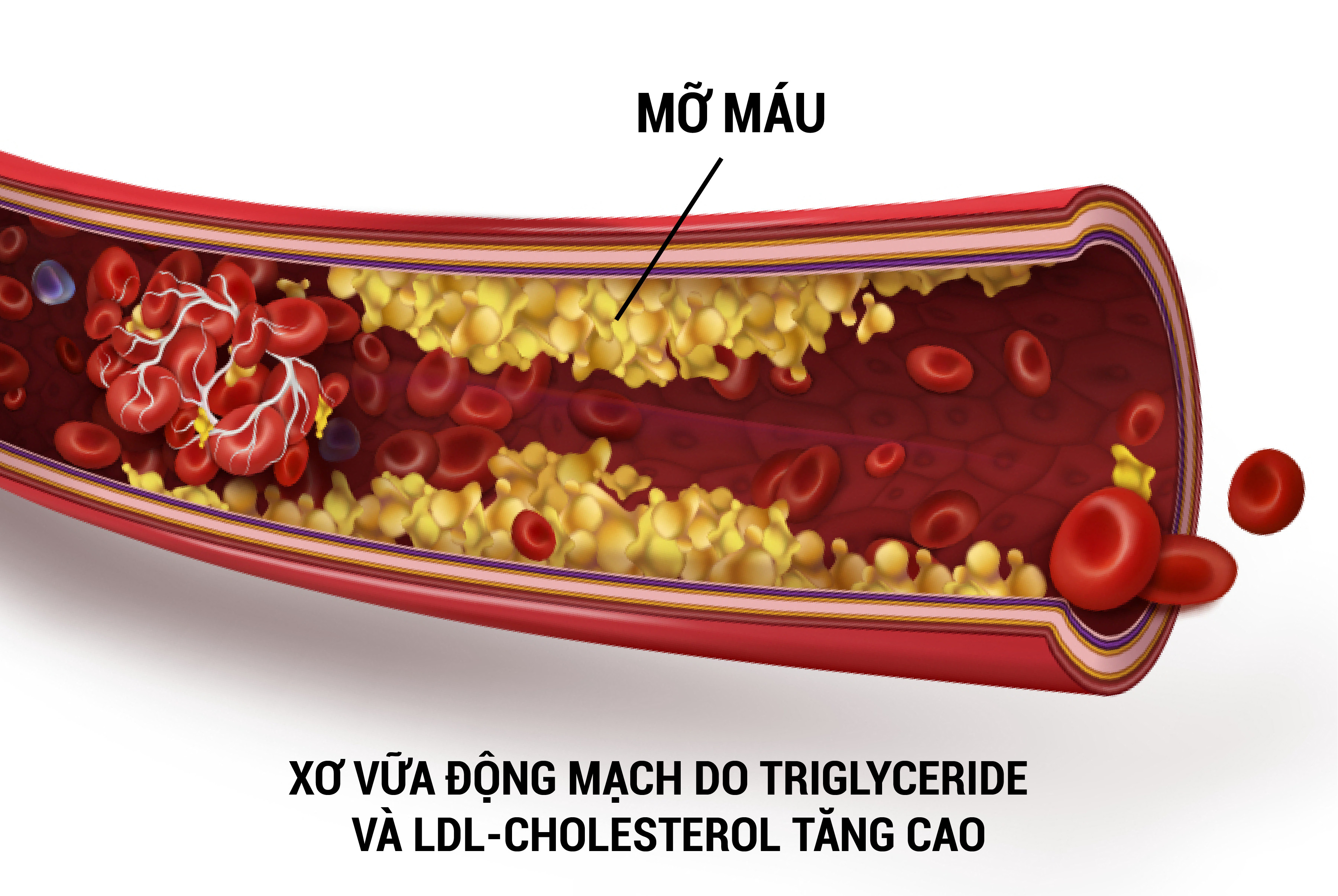 Triglyceride tăng: Tập sức mạnh có giúp cải thiện chỉ số mỡ máu? - Ảnh 3.
