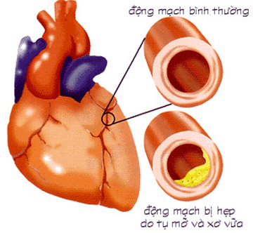 Những bệnh dễ “vận vào người” 1